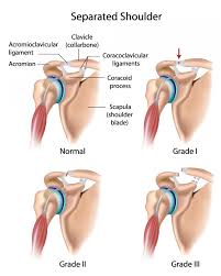 Shoulder Separation, Motion Works Physiotherapy Stittsville, Stittsville