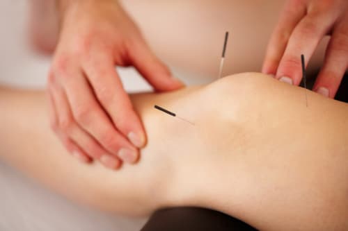 Acupuncture, Motion Works Physiotherapy Stittsville, Stittsville