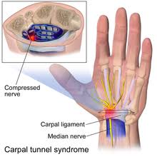 Carpal Tunnel, Motion Works Physiotherapy Stittsville, Stittsville