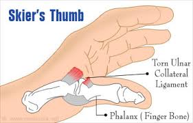 Skiers Thumb, Motion Works Physiotherapy Stittsville, Stittsville