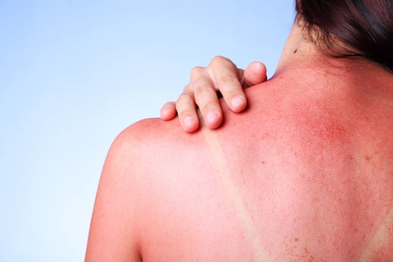 Sunburn